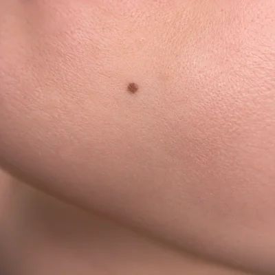 Close-up of a small beauty mark on the cheek
